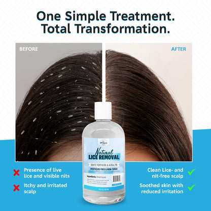 Lice Removal Treatment